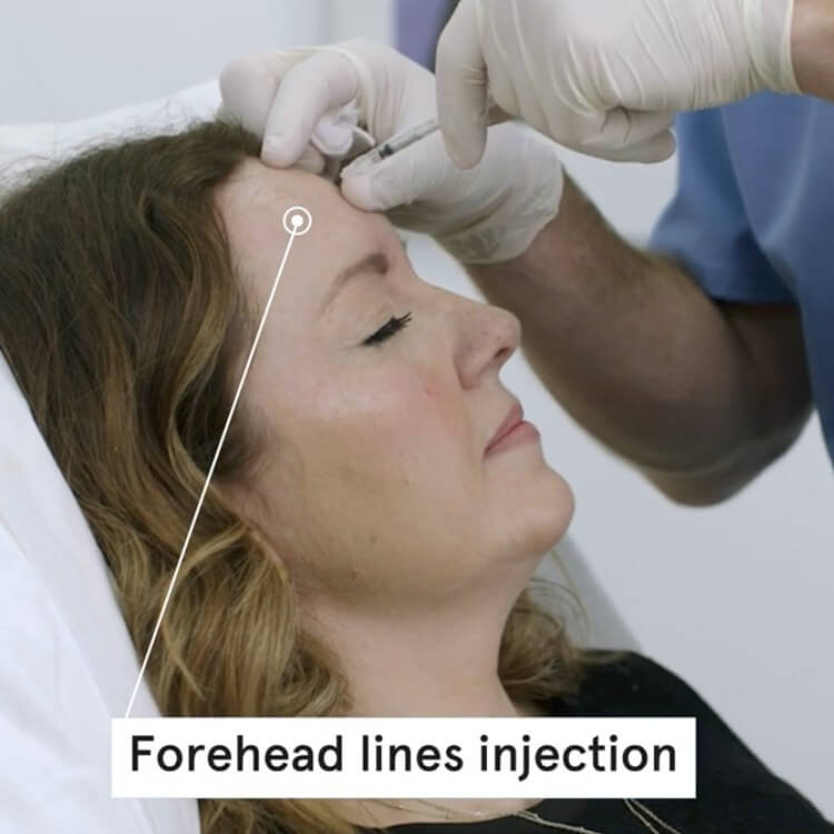 Forehead and frown line treatment - fast and effective injections. See demo and before/after photos.