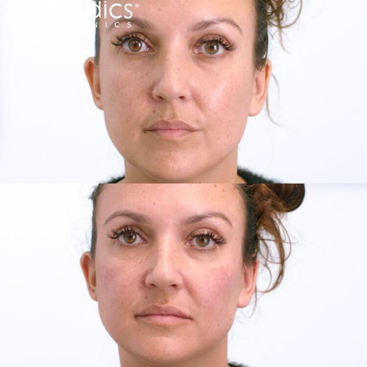 Cheek enhancement fillers that look natural and fabulous - see photos and demo