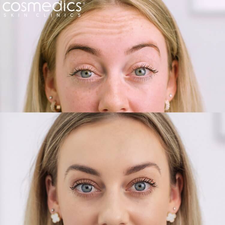 BOTOX Forehead Before & After Lisa