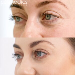 BOTOX Crows Feet Before & After Lisa