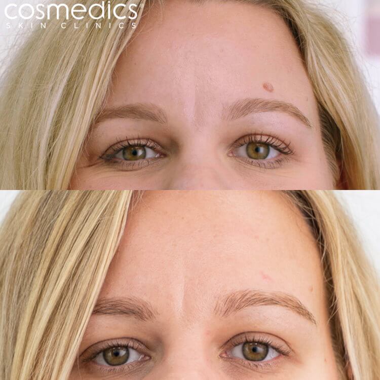 Mole Removal Above Eyebrow Before & After