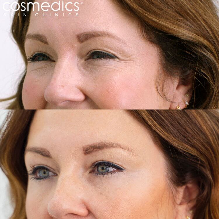 BOTOX Crows Feet Before & After Charlotte