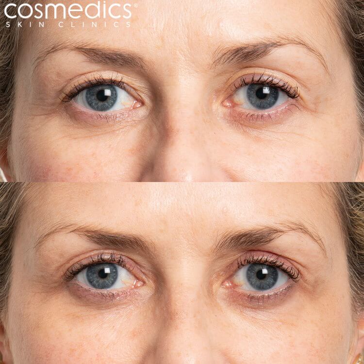 upper blepharoplasty before and after photos