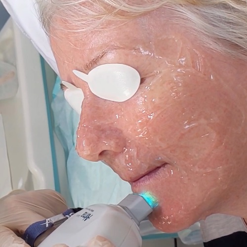Laser facial treatment for redness and veins 