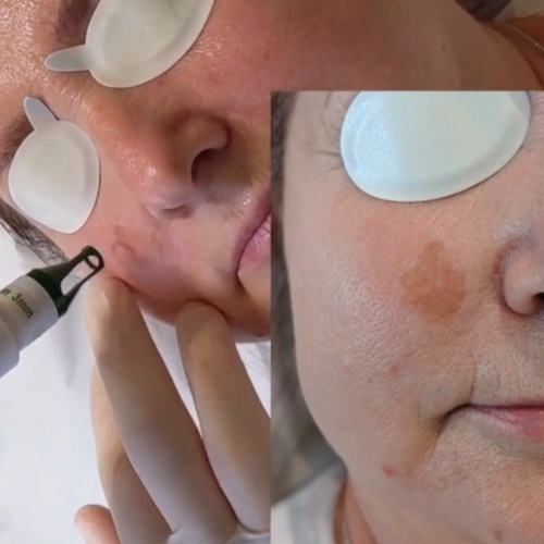 Laser for facial pigmentation & sun damage